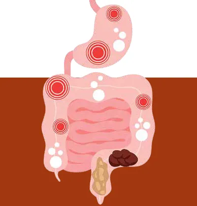Inflammatory Bowel Disease