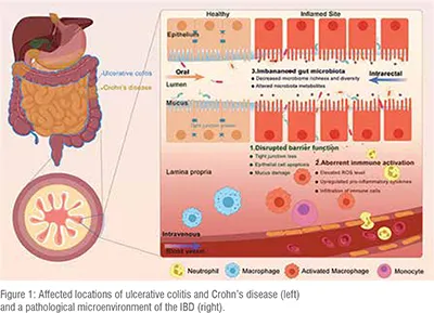 Crohn’s Disease (CD) and Ulcerative Colitis (UC)