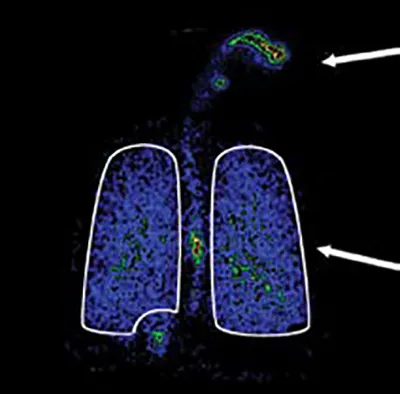 Lung targeted therapy