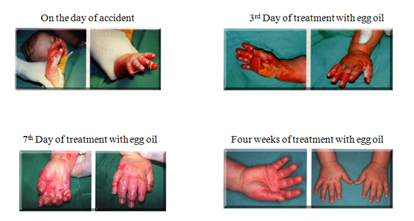 3rd degree burn scar hand