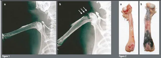 Femur bones (long bones) before and after the skeletal metastase development